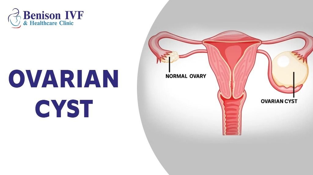 Management Of Ovarian Cyst At Benison IVF Centre